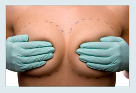 breast augmentation