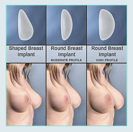 implants