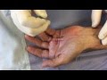 Needle Cordotomy 